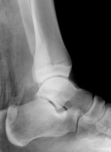 Figure 5 Salter Harris III distal tibia physeal_Lat